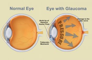 Measuring Eye Pressure (IOP)