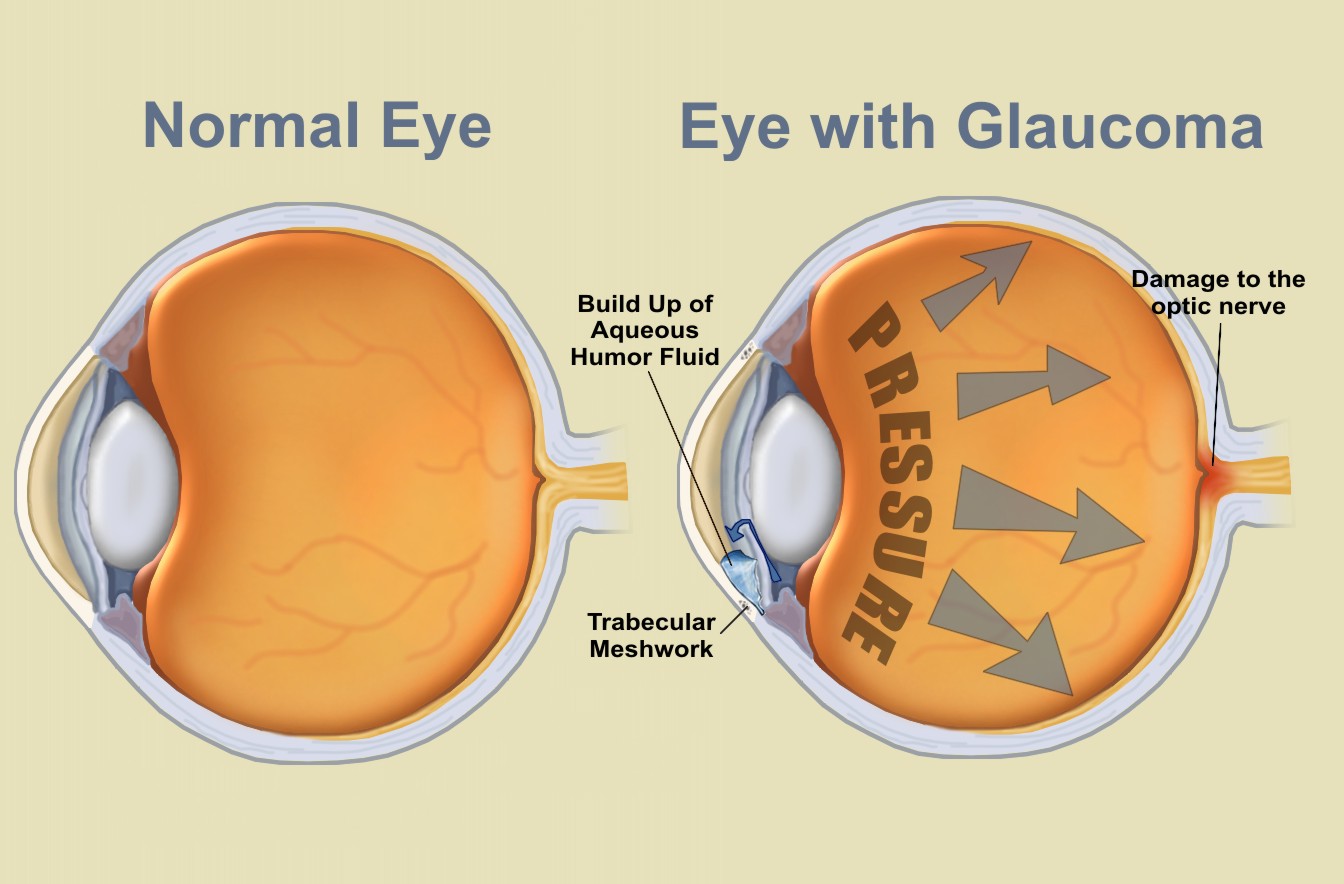 Eye with glaucoma