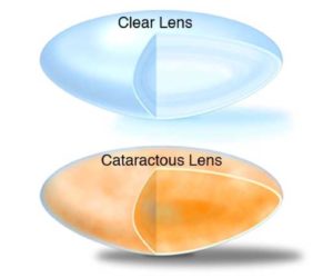 Cataract vs Clear Lens