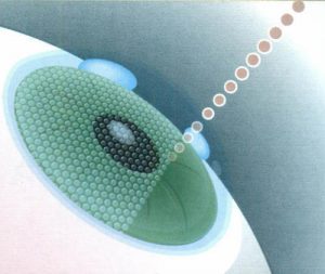 Intralase flap creation